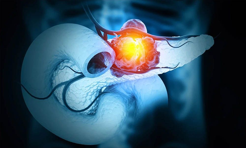 स्पेनी वैज्ञानिकहरूले प्यान्क्रियाटिक क्यान्सरको उपचार पत्ता लगाएको दाबी